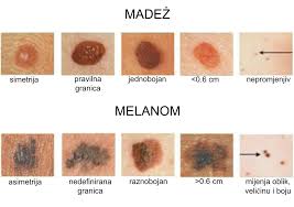 Besplatni pregledi madeža u Bakru